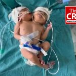दो सिर-दो दिल वाली बच्ची का जन्म: सोनोग्राफी और एक्स-रे में नहीं हुआ था खुलासा, डॉक्टर भी हैरान, हालत नाजुक